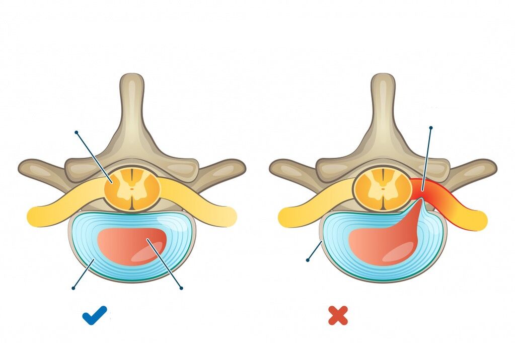 intervertebral discs, one healthy and the other with a hernia