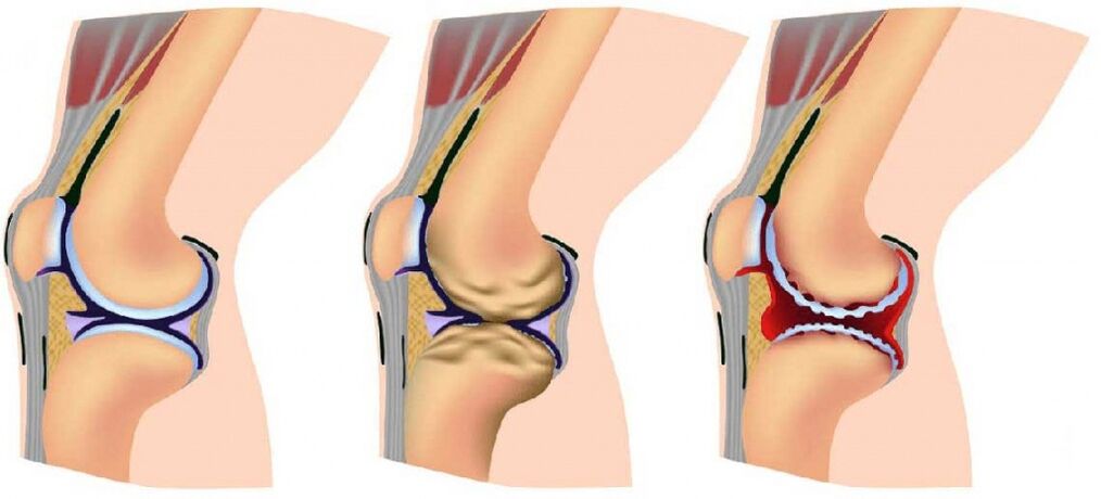 Healthy articulation and affected by osteoarthritis