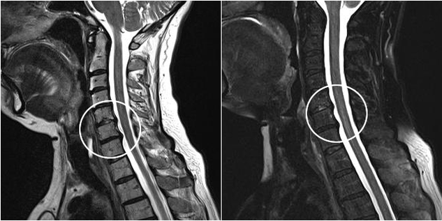 Cervical osteochondrosis on magnetic resonance image
