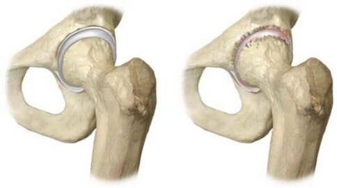 healthy hip joint affected by osteoarthritis